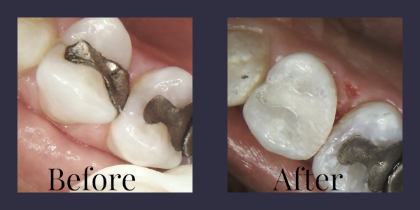 Before and After Replacing an Amalgam Filling With a Composite Filling